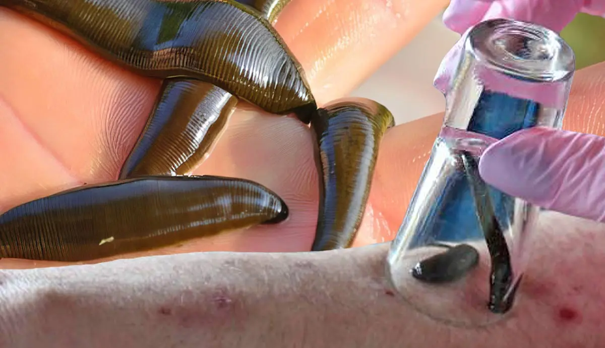 Do Leeches Help with Health Problems?