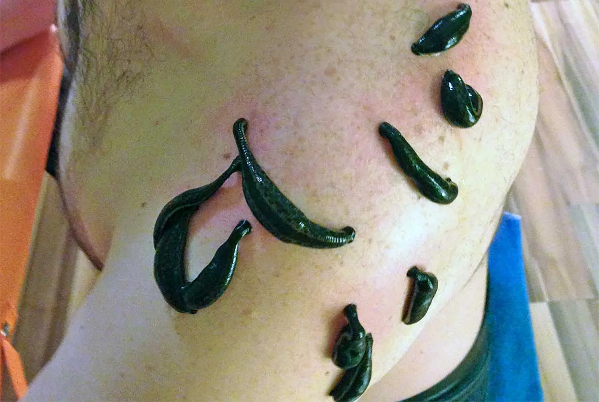 a bunch of leeches on a guy