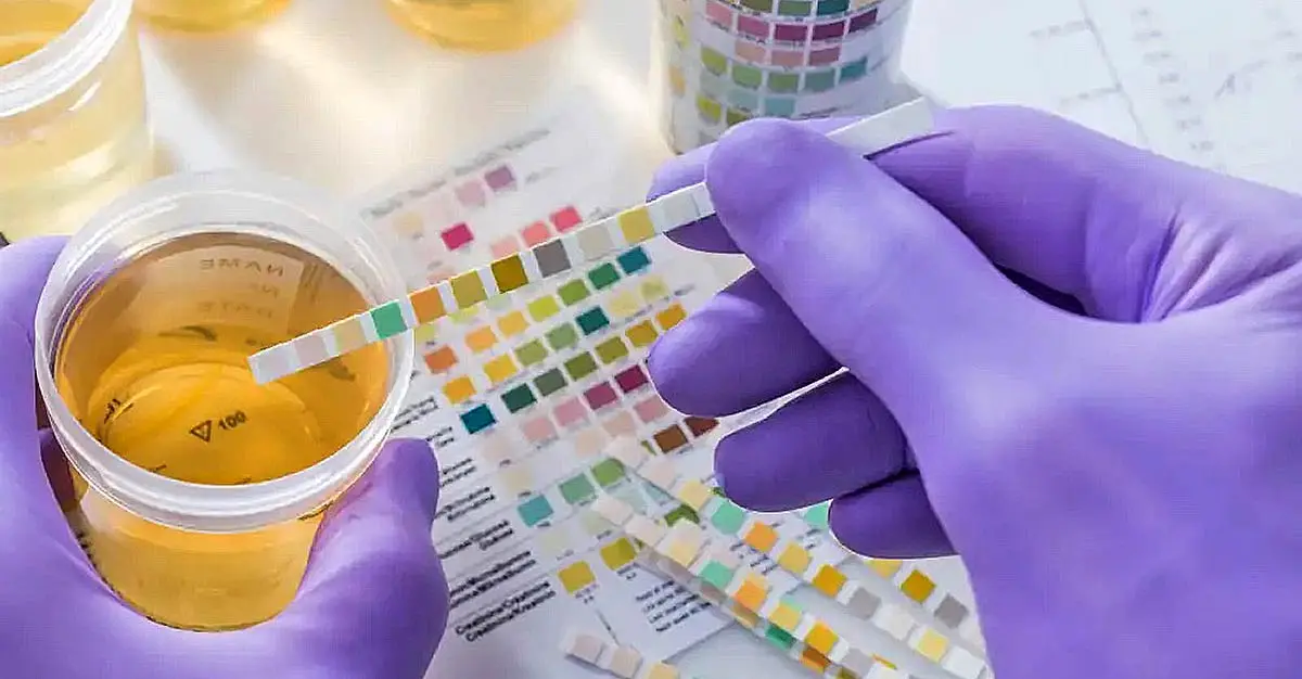 urinalysis urine test